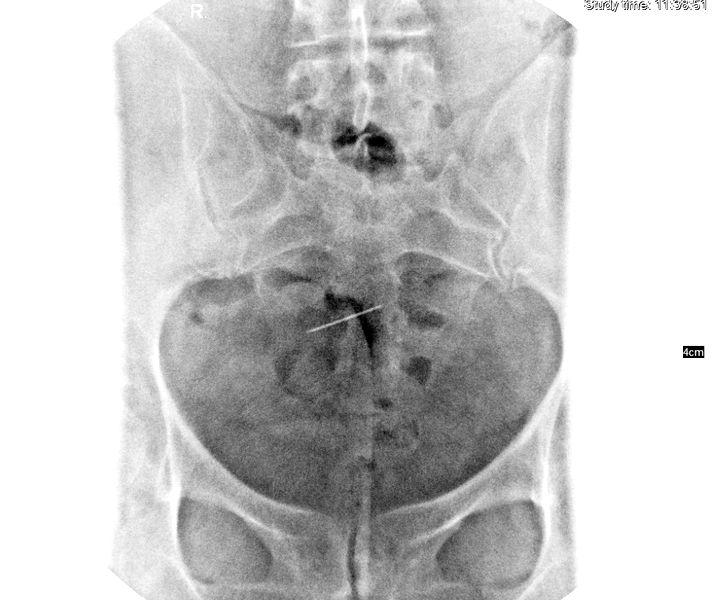 Medicii din Iași au făcut o descoperire șocantă în corpul unei paciente! De 30 de ani avea un ac uitat în zona genitală