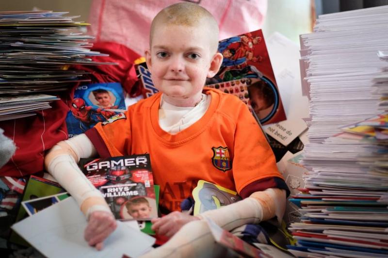 Un băiat de 14 ani și-a dorit să moară, fiindcă nu a mai suportat durerea! Boala cumplită ce-i face pielea să cadă!