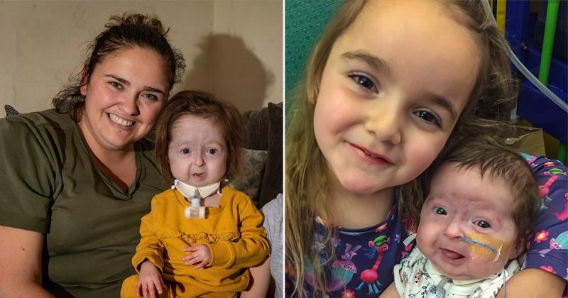 O fetiță de doi ani suferă de „boala lui Benjamin Button”! Este singurul om diagnosticat cu această maladie! Cum arată copila care uimește medicii – FOTO