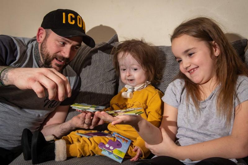 O fetiță de doi ani suferă de „boala lui Benjamin Button”! Este singurul om diagnosticat cu această maladie! Cum arată copila care uimește medicii – FOTO