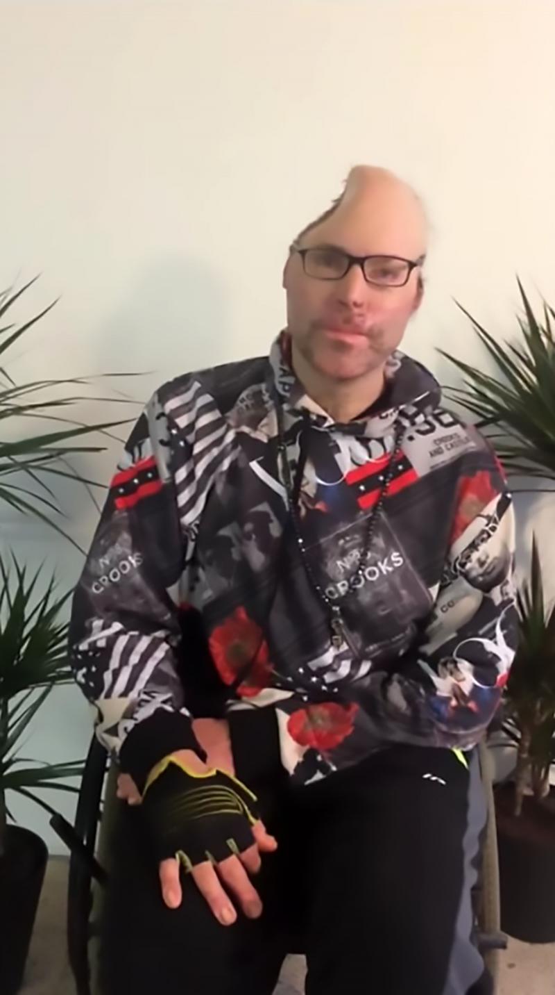 VIDEO/ A rămas mutilat pe viață! Un rapper și-a pierdut jumătate din cap într-o explozie provocată la un laborator de droguri