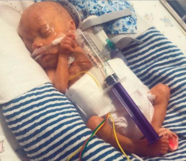 „Ne pregăteam să îi spunem adio, când a avut loc o minune”. Un bebeluș de mărimea unei seringi sfidează moartea. Galerie foto