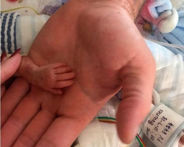 „Ne pregăteam să îi spunem adio, când a avut loc o minune”. Un bebeluș de mărimea unei seringi sfidează moartea. Galerie foto