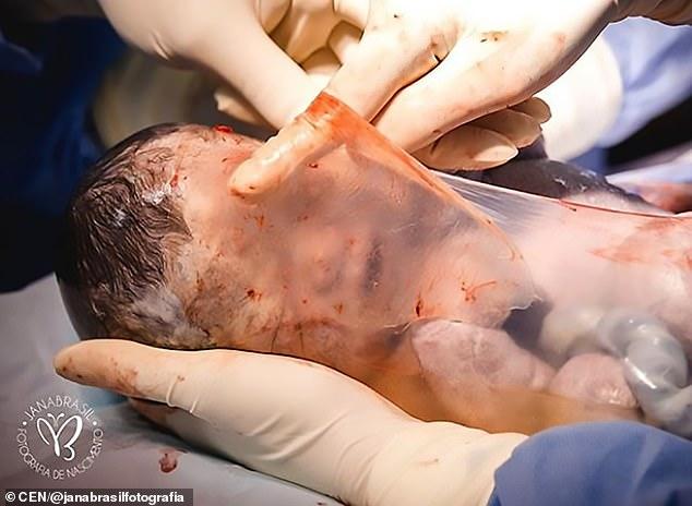 Bebelușul născut în balon. Imagini senzaționale de la cea mai rară naștere! „Oamenii spun că bebelușul meu semăna cu un extraterestru. Am plâns când l-am văzut”