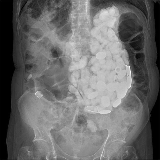 Un bărbat a ajuns la spital și medicii au fost șocați! Ce au găsit în stomacul pacientului