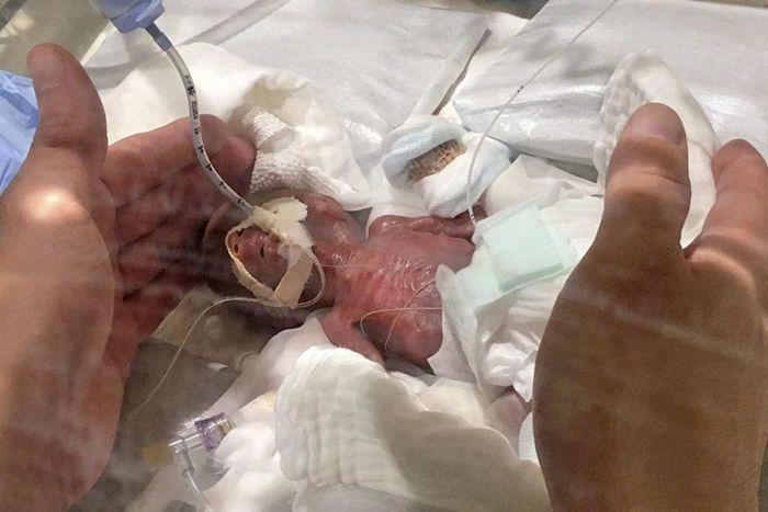 Cât o doză de suc! Cel mai mic copilaș din istorie născut prematur, a supraviețuit: 268 de grame!!!