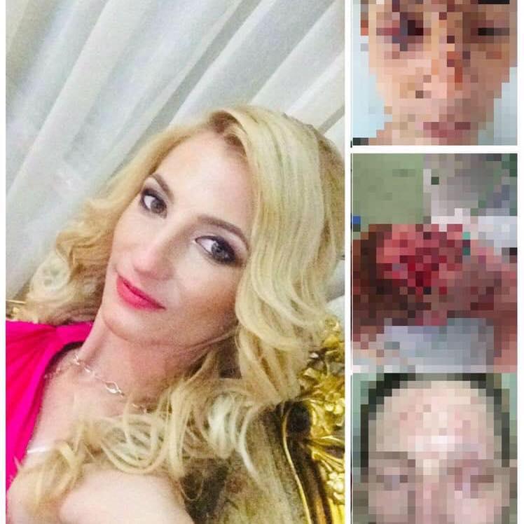 Dreptate pentru Ana, fata din Constanța, mutilată într-un accident rutier: "Fața mea e de monstru acum". Șoferul vinovat, șef de post, era băut