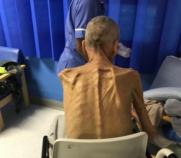 Este piele și os și abia poate să meargă, dar a fost trimis la muncă! Un bărbat de 38 de kilograme a fost lăsat fără ajutor social