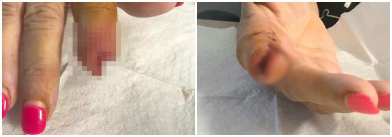 S-a dus la salon pentru o manichiură. Câteva zile mai târziu, medicii au fost nevoiți să îi amputeze o parte din deget „I se poate întâmpla oricui, trebuie să fiți mereu atente!”
