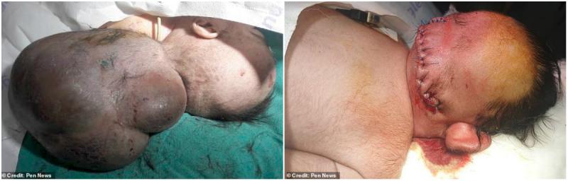 Copilul lui s-a născut cu două capete. Îngrozit, tatăl lui l-a îngropat de viu. Doar un miracol a făcut ca cel mic să fie salvat și dus la un spital