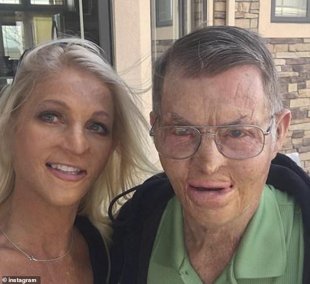 Și-a îndeplinit visul după 38 de ani! O femeie care a suferit arsuri pe 70 la sută din suprafața corpului a defilat pe podium