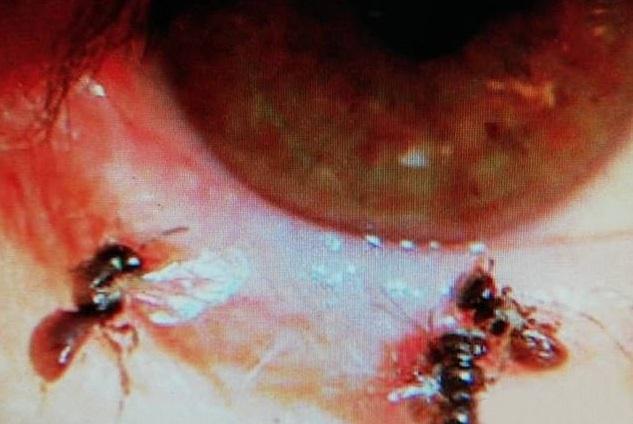 O femeie a ajuns de urgență la spital după ce a trăit ore în șir cu albine în ochi! Medic: ”Se hrăneau cu lacrimele ei!”