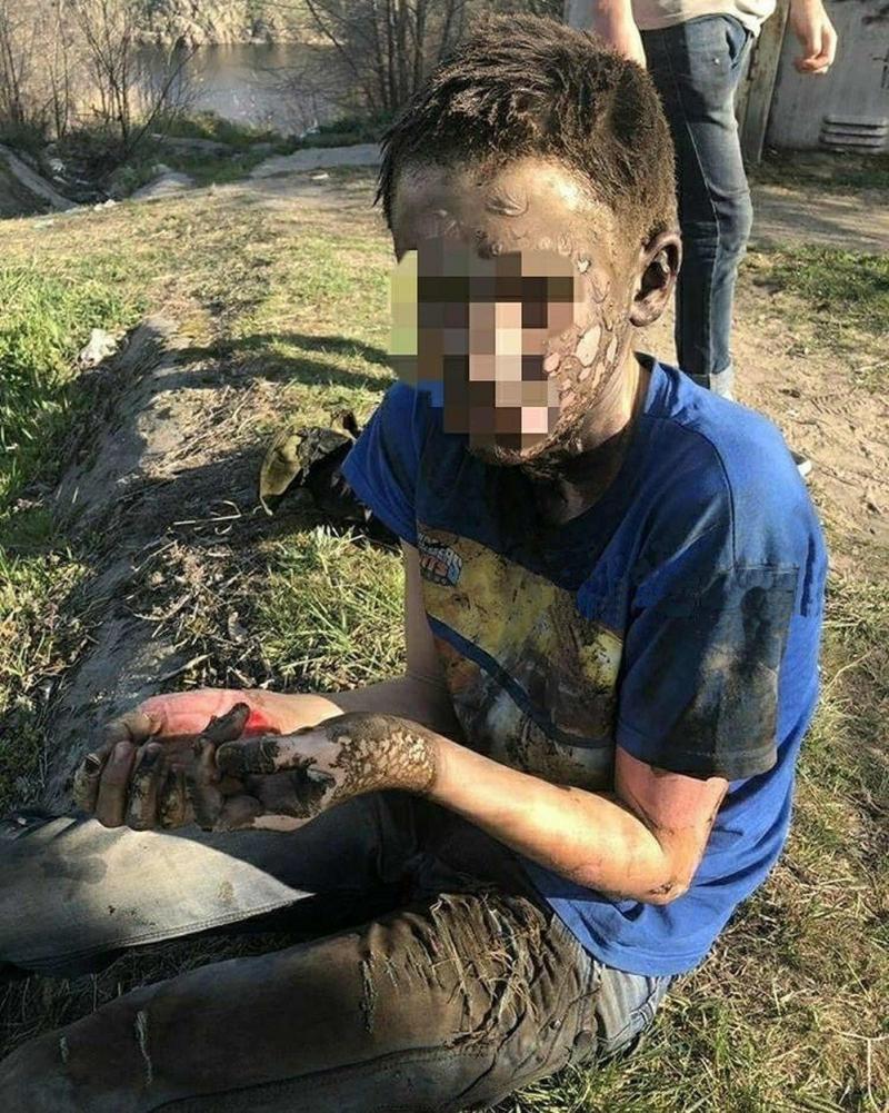 Un puști de 14 ani s-a curentat la 10.000 de volți și a supraviețuit! Medicii: ”E cel mai norocos!”