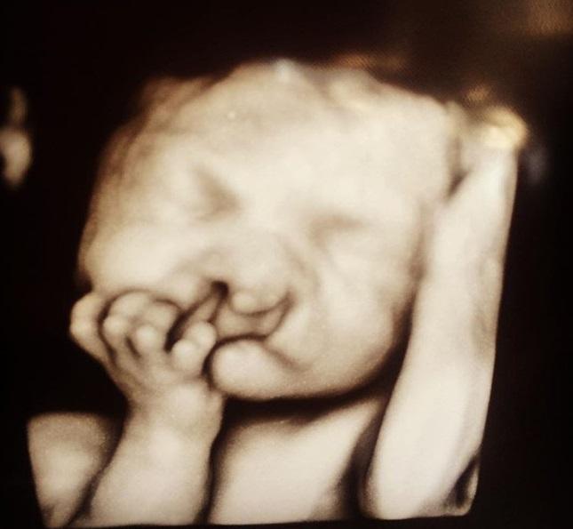 Părinții au vrut să vadă bebelușul la ecografie, dar au trăit un șoc! Ce a apărut pe monitor și cum s-a născut copilul