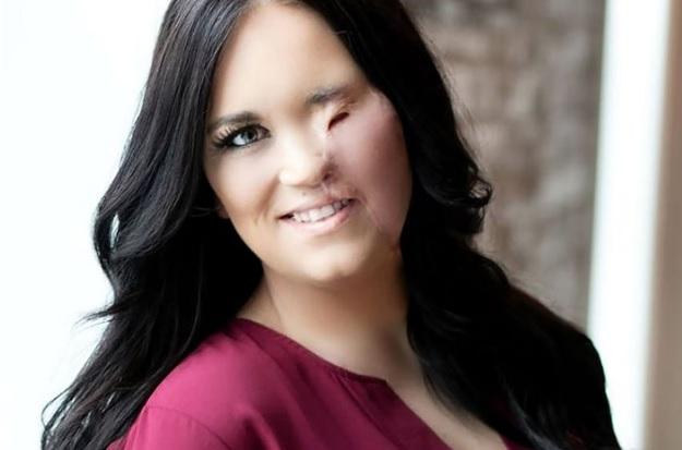 A vrut să își aranjeze părul, dar a rămas desfigurată pe viață! „Mi-a luat mult până mi-am făcut curaj să mă uit în oglindă”. Imagini șocante - Foto