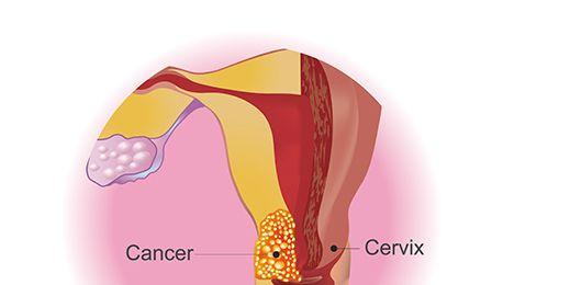 Studiu privind vaccinul anti-HPV: Cancerul de col uterin ar putea fi eradicat