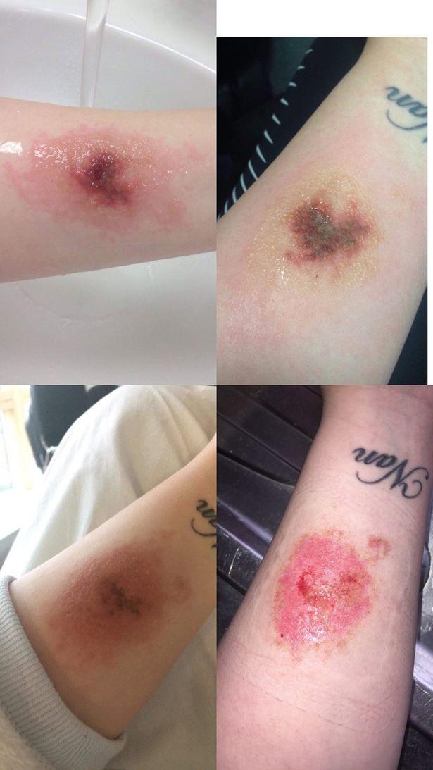 O femeie a pus soluție pe aragaz, dar apoi a început coșmarul! „Am văzut efectiv cum pielea mea...”