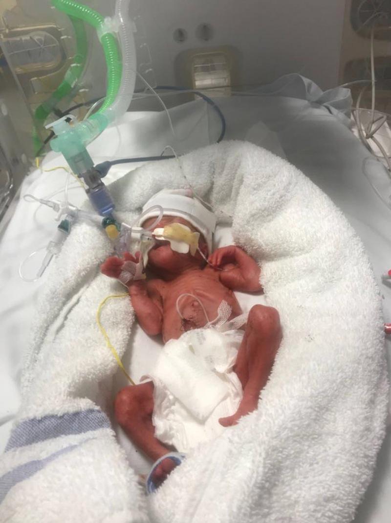 Cântărea 700 de grame când a venit pe lume și i se puteau vedea organele prin piele! Cum arată fetița acum, când a împlinit un an