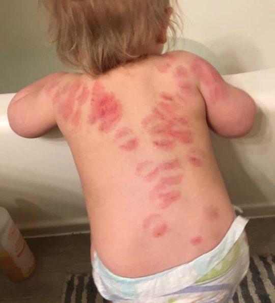 Și-a luat bebelușul de la grădiniță plin de urme de mușcături: „Ce credeau, că nu voi observa? Ți se întoarce stomacul pe dos!”