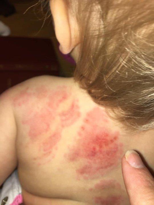 Și-a luat bebelușul de la grădiniță plin de urme de mușcături: „Ce credeau, că nu voi observa? Ți se întoarce stomacul pe dos!”