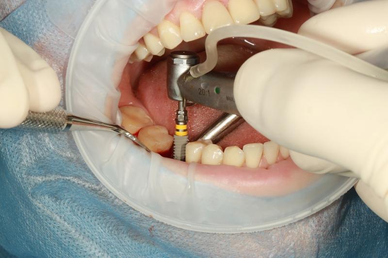 Ce înseamnă un implant dentar