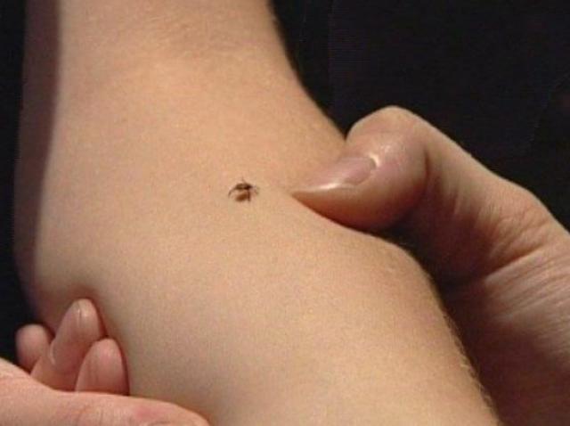 Mușcătura De Căpușe La Copii și Adulți Cum Arată și Ce E Important Să știi Antena 1