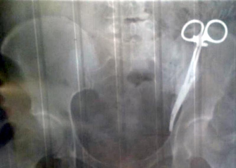 A trăit 23 de ani cu dureri cumplite. Când și-a făcut o radiografie, medicilor nu le-a venit să creadă ce au văzut: „Erau convinși că era o farsă”