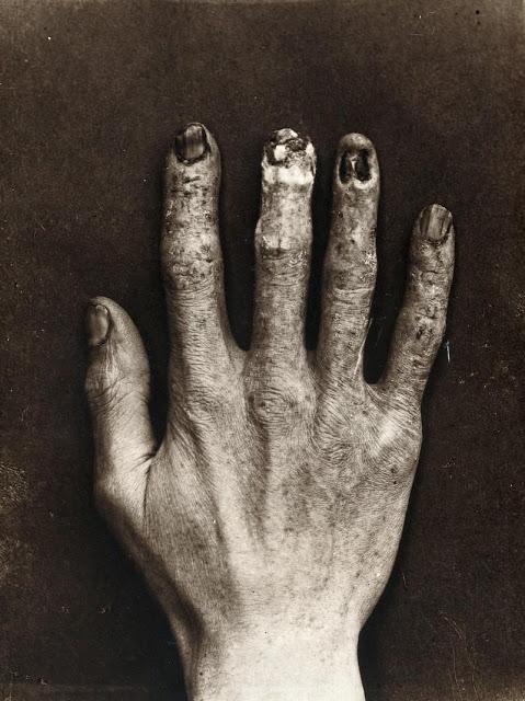 Mort la 39 de ani. Mâna dreaptă a mâinii drepte a lui Edison. ”Nu-mi vorbiți despre razele-X, îmi este frică de ele!”