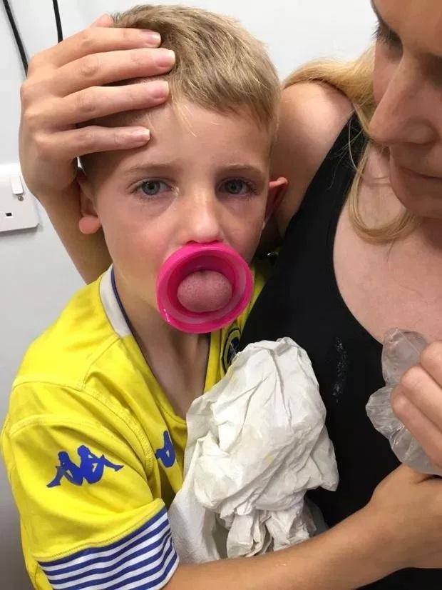 Un copil de șase ani la un pas de moarte după ce i-a rămas limba blocată într-o sticlă de apă. Zece doctori și patru specialiști i-au salvat viața