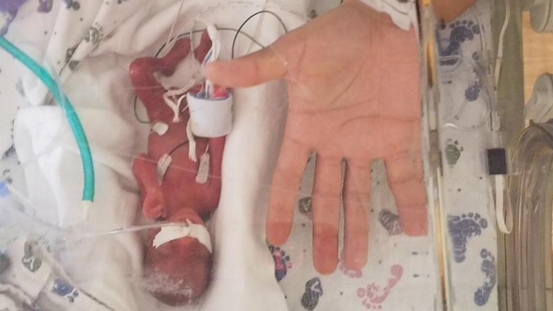 Copilul minune s-a născut la doar 23 de săptămâni și are 400 de grame. „Sunt atât de mândră de el”