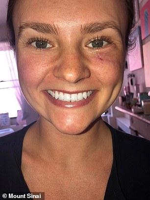 O femeie a rămas șocată după ce a aflat că iritația pe care o avea sub ochiul stâng s-a transformat în cancer de piele. Cauza ar fi radiațiile solare