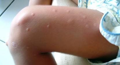 Încălzirea globală aduce cinci specii de țânțari în România