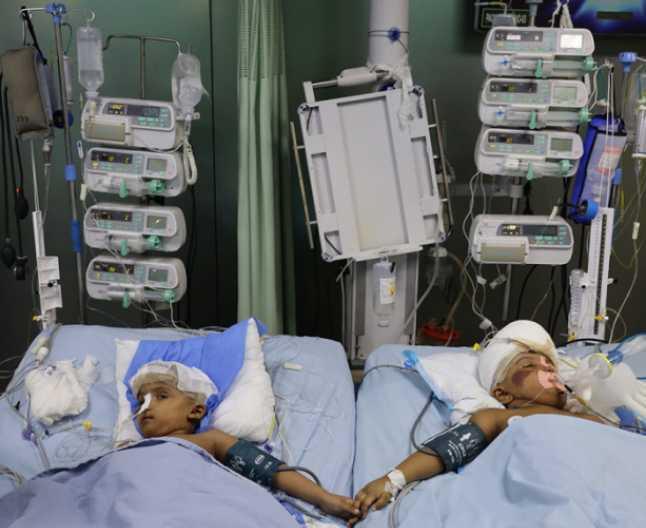 Două surori au venit pe lume unite în zona frunții, iar acum au fost separate, în urm unei operații de peste 30 de ore! Una dintre fetițe a deschis ochii