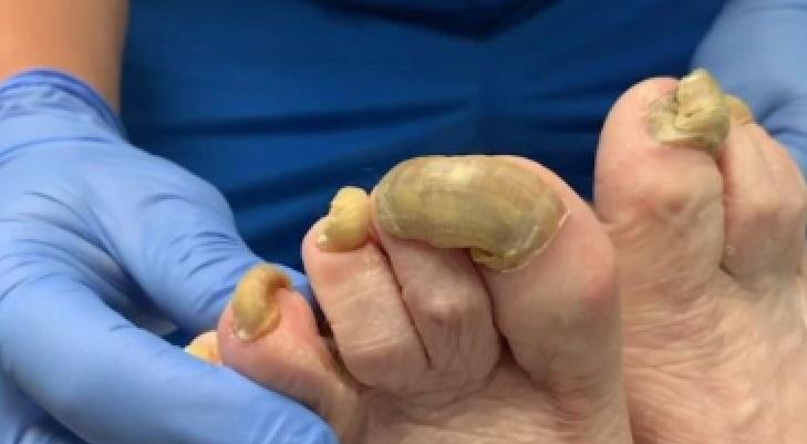 O femeie nu și-a mai tăiat unghia timp de un an, din cauza unei ciuperci! Medicii s-au îngrozit de rezultat