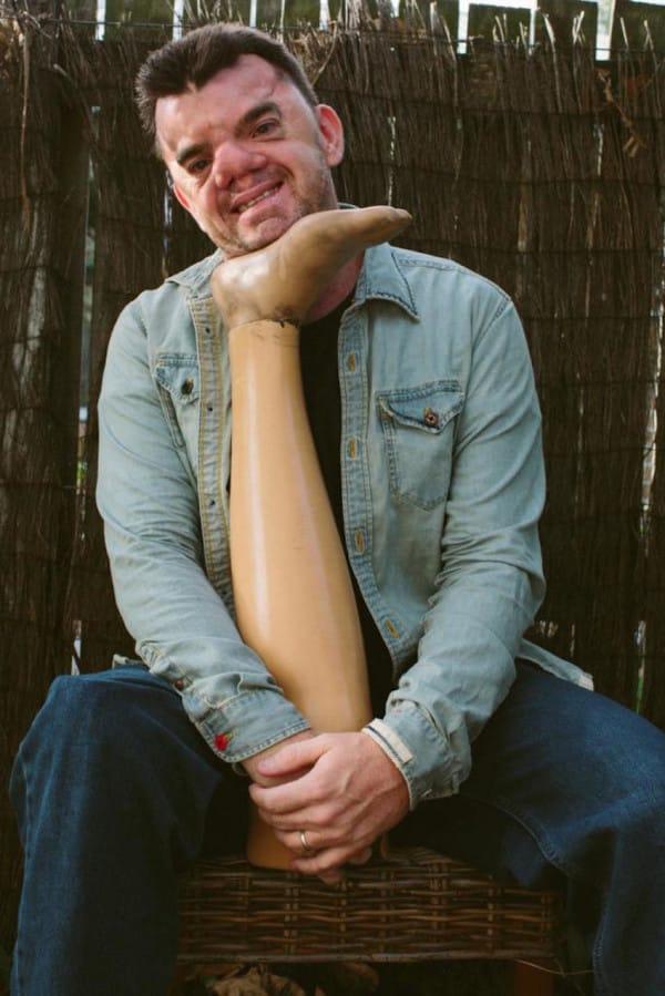 Abandonat la naștere pentru că era prea urât! "Pedeapsă de la Dumnezeu? Am născut un monstru!" Cine este copilul a cărei viață este unică