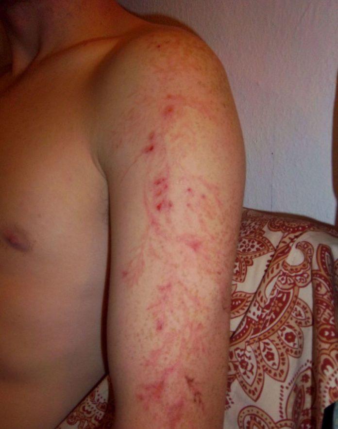 Imagini cu puternic impact emoțional! Așa arată trupurile lovite de fulgere!