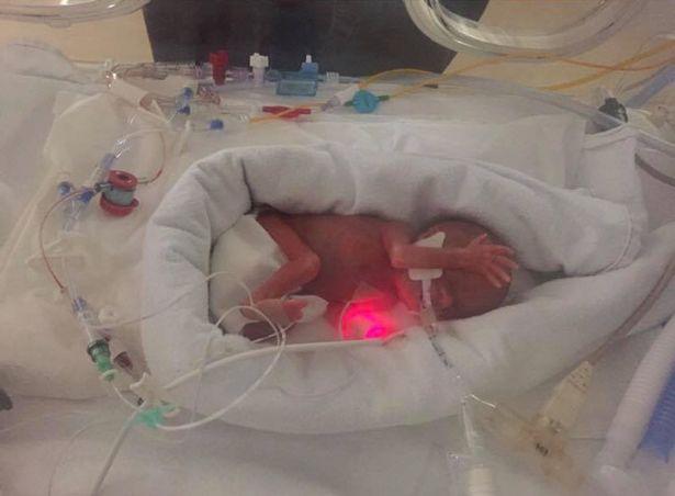 Cum arată u bebeluș de 340 de grame, născut prematur! Medicii nu i-au dat nici o șansă, dar azi arată senzațional | FOTO