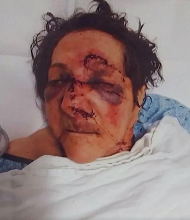 O femeie în vârstă de 86 de ani a fost maltratată de îngrijitoarele de la centru: „Are fracturi duble la nivelul feței, nasul rupt și e cusută pe toată fața”
