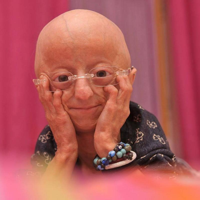 Povestea Claudiei, fata care s-a născut bătrână: „Am doar 20 de ani, dar arăt de 140. Viața, oricât ar fi de scurtă, trebuie trăită din plin”