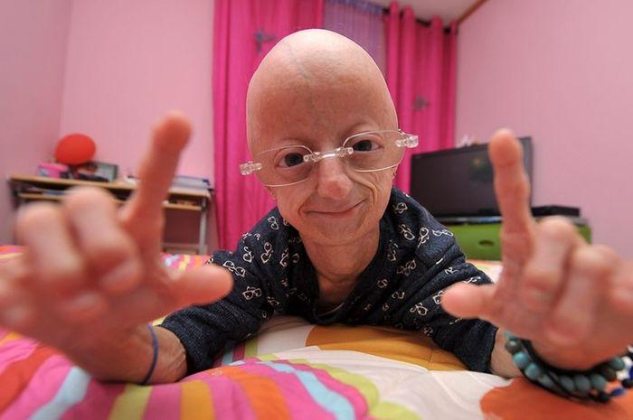 Povestea Claudiei, fata care s-a născut bătrână: „Am doar 20 de ani, dar arăt de 140. Viața, oricât ar fi de scurtă, trebuie trăită din plin”