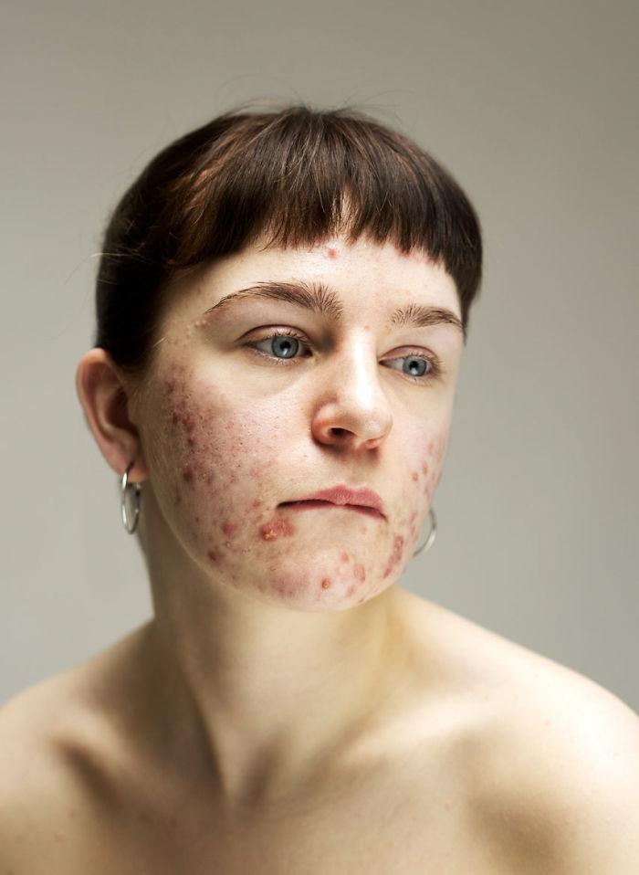 FOTO |  Un alt fel de artă? Acneea i-a distrus toată adolescența, iar acum încearcă să transforme afecțiunile pielii în "frumos"