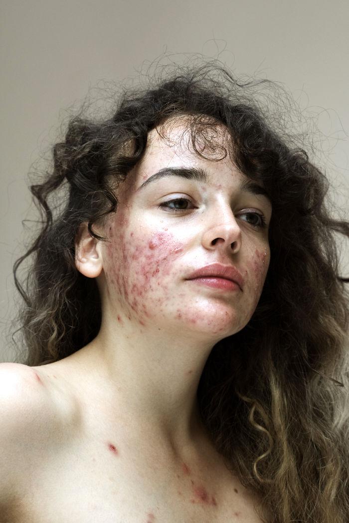 FOTO |  Un alt fel de artă? Acneea i-a distrus toată adolescența, iar acum încearcă să transforme afecțiunile pielii în "frumos"