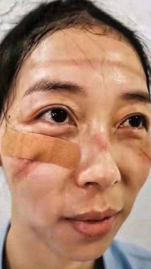 Imagini teribile din China. Medicii care tratează pacienții cu coronavirus sunt desfigurați din cauza echipamentelor