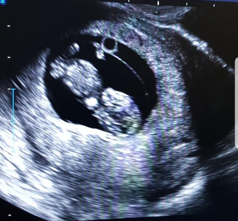 O mai ții minte pe Cornelia de la ”Mireasă pentru fiul meu”? Fosta iubită a lui Dragoș și-a refăcut viața și e însărcinată