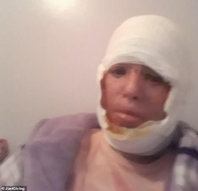 O mamă a fost desfigurată de soț în timp ce dormea. Bărbatul i-a turnat ulei fierbinte pe față: ”Nu poate să vadă sau să vorbească. E de nerecunoscut!”