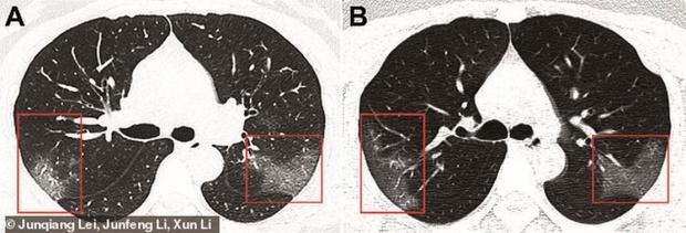 Ăștia sunt plămânii unui pacient infectat cu coronavirus! Radiografia arată efectele COVID-19 în organismul unei tinere de 33 de ani