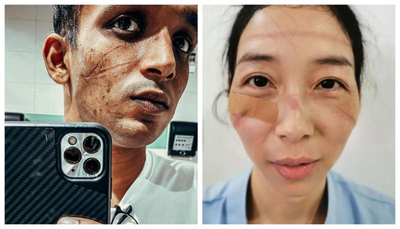 Poți să îi privești? Au fețele pline de răni! Așa arată chipurile salvatorilor, în lupta împotriva COVID-19! „Lucrăm fără încetare! Fiecare viață contează!” - FOTO