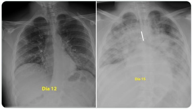 Medic spaniol: "Vă credeți nemuritori? Priviți" Cum s-au "măcinat" plămânii unui tânăr de 28 de ani, în doar trei zile de la infectarea cu Covid-19