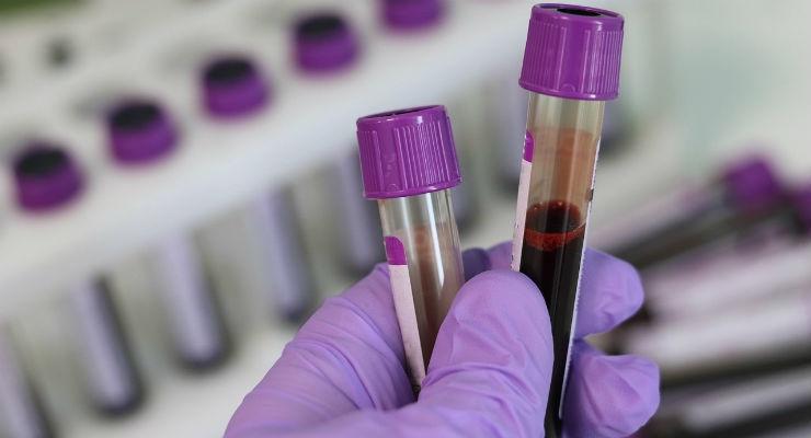 Descoperire neașteptată în sângele prelevat de la pacienții cu Covid-19! Ce au descoperit medicii