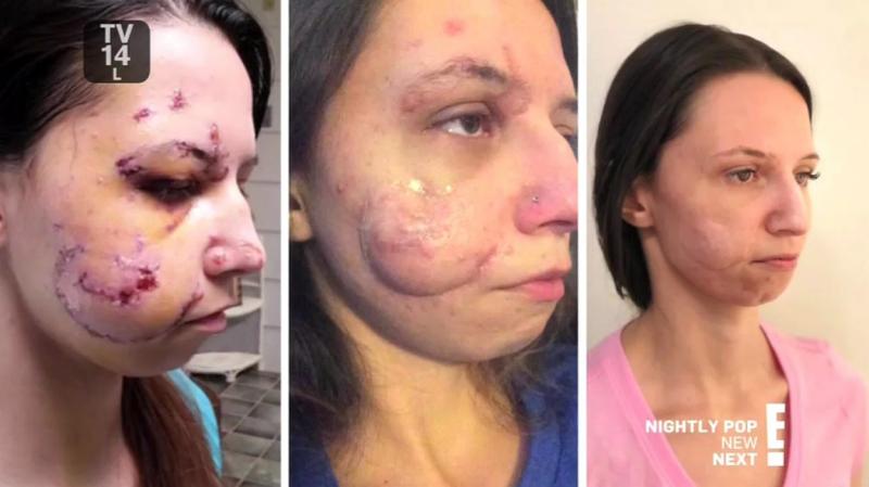 Tânără desfigurată în urma unui accident rutier: ”Medicii m-au lăsat ore în șir să sângerez, având cioburi în față!” Cum arată acum, după o operație de reconstrucție facială”